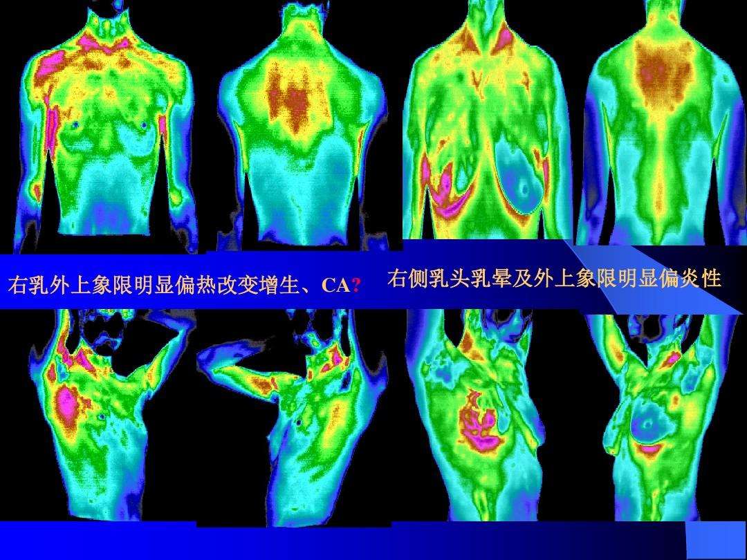 医用红外热成像检测技术在疼痛领域中的应用